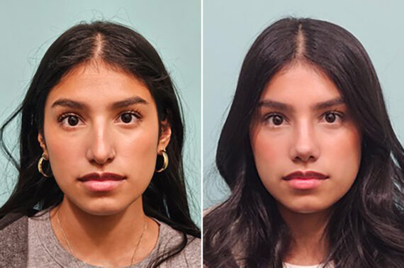 Before and after Rhinoplasty by Dr. Shervin Naderi, Patient 49893