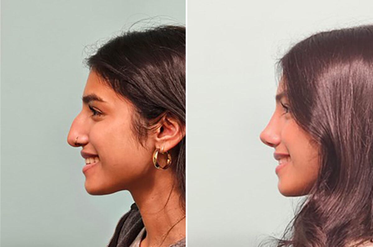 Before and after Rhinoplasty by Dr. Shervin Naderi, Patient 49893