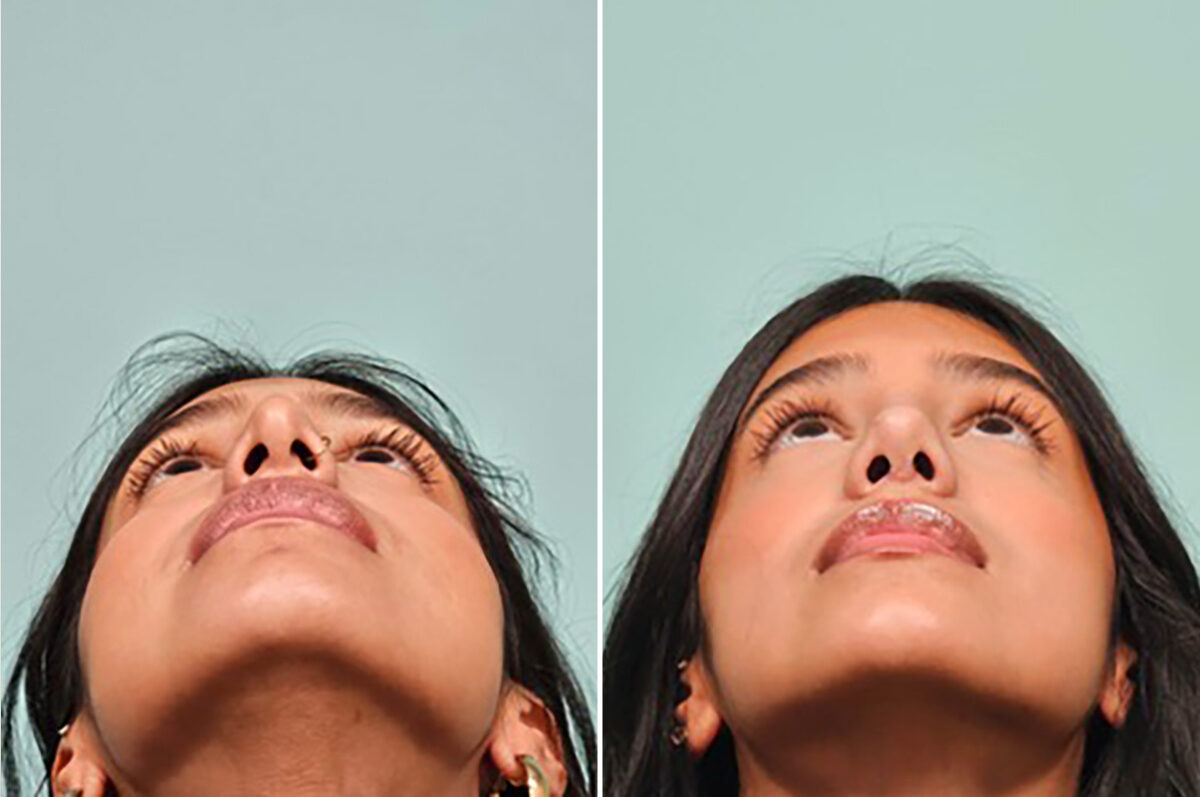 Before and after Rhinoplasty by Dr. Shervin Naderi, Patient 49893