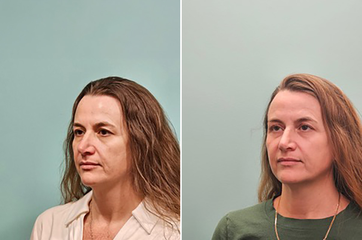 patient-50261-skin-resurfacing-before-after