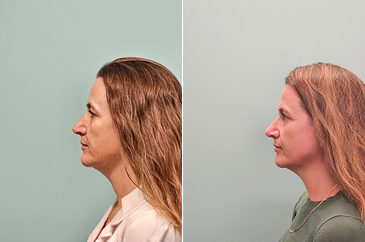 Before and after Skin Resurfacing by Dr. Shervin Naderi, Patient 50261