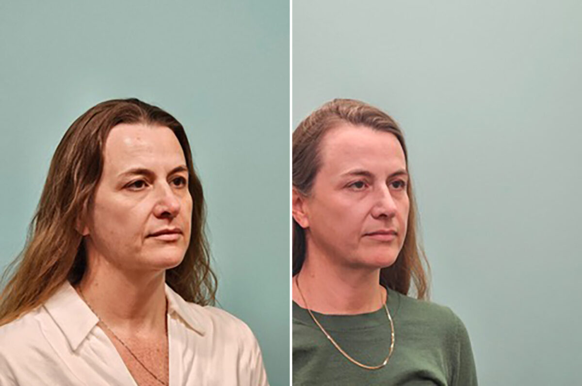 Before and after Skin Resurfacing by Dr. Shervin Naderi, Patient 50261
