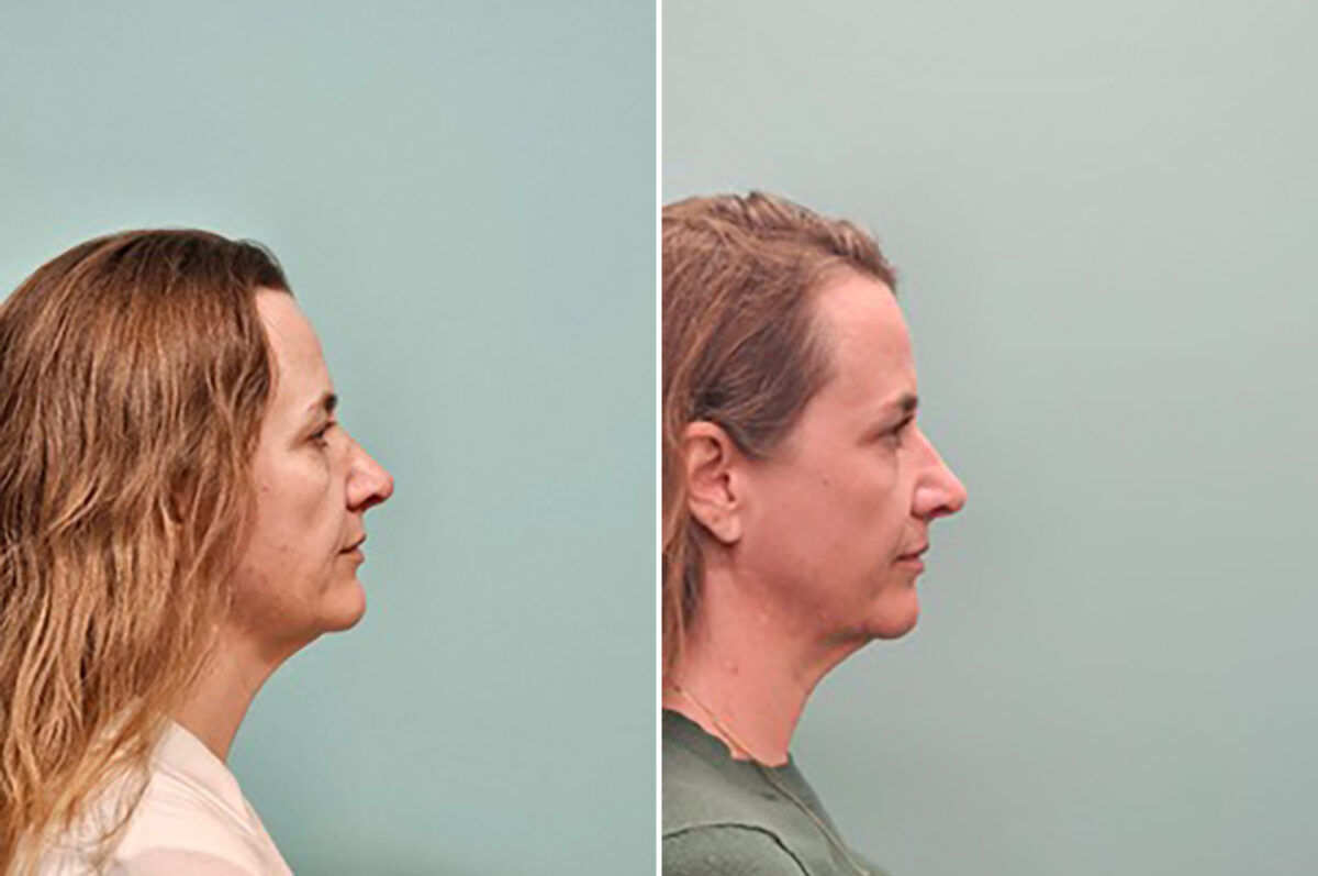 Before and after Skin Resurfacing by Dr. Shervin Naderi, Patient 50261