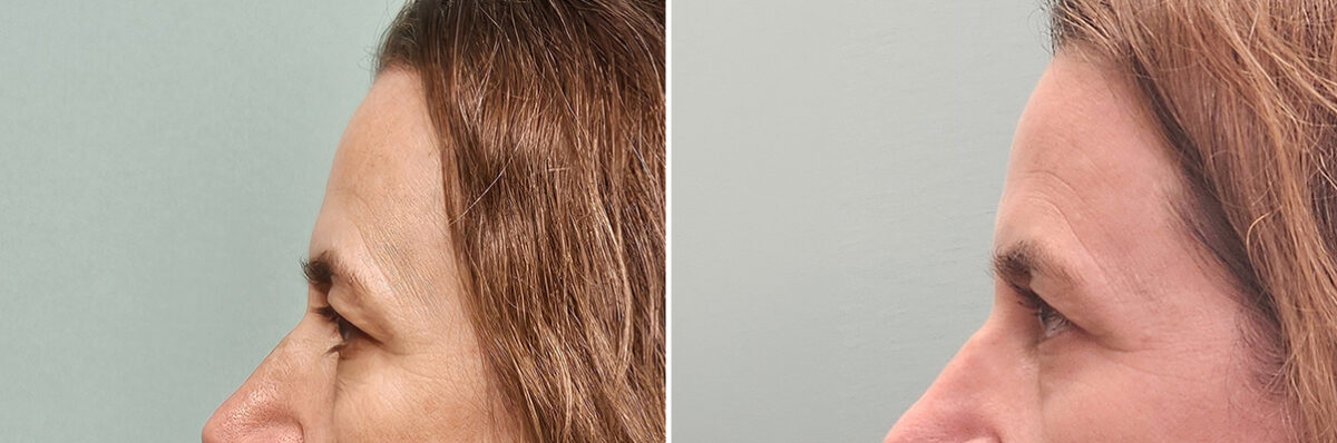 Before and after Skin Resurfacing by Dr. Shervin Naderi, Patient 50261