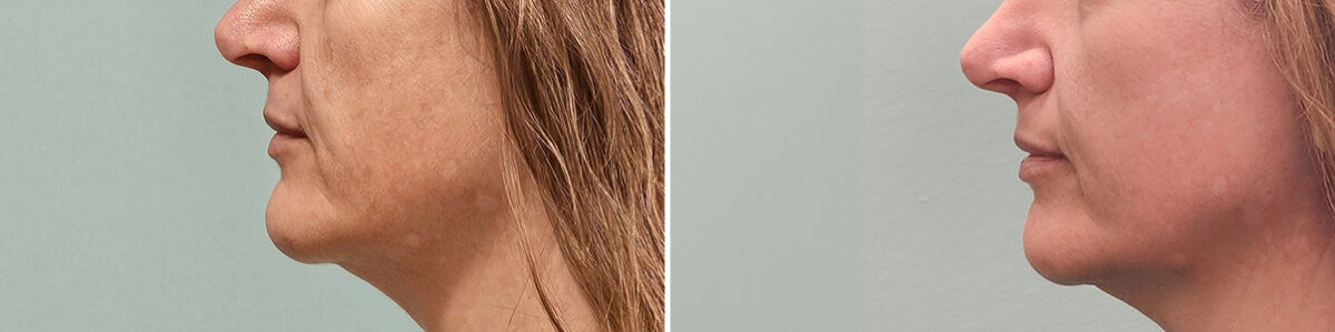 Before and after Skin Resurfacing by Dr. Shervin Naderi, Patient 50261