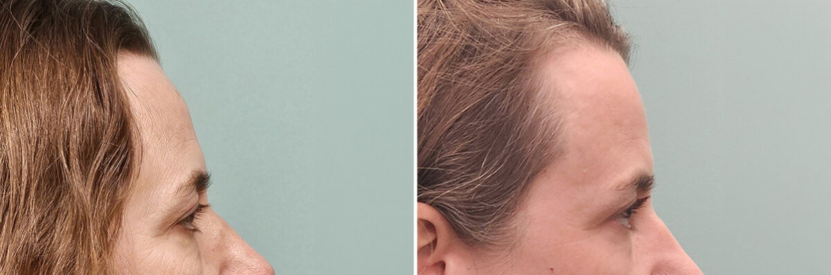 Before and after Skin Resurfacing by Dr. Shervin Naderi, Patient 50261