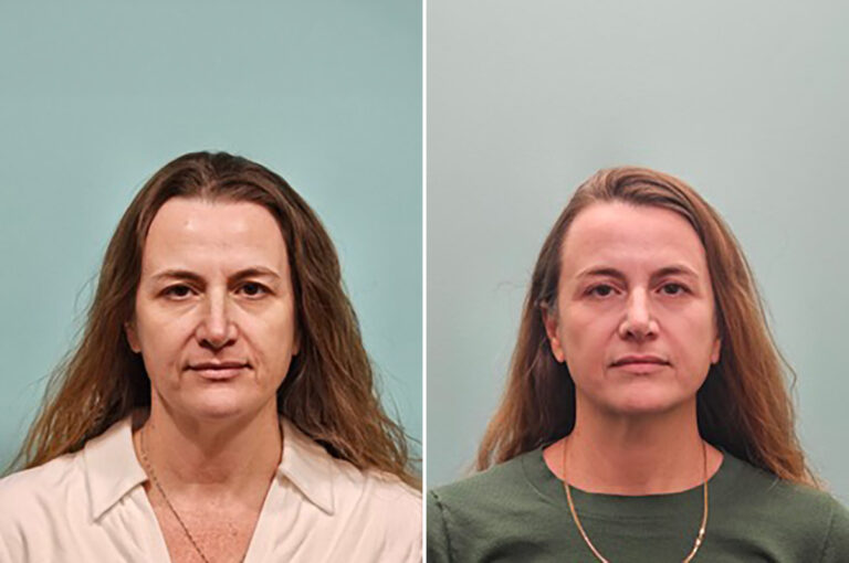 UltraClear laser resurfacing before and after: smoother, more even skin for a 50-year-old woman