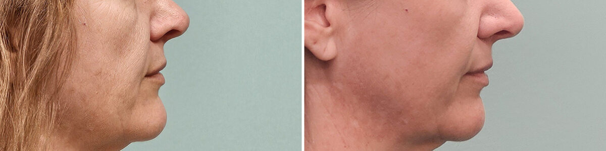 Before and after Skin Resurfacing by Dr. Shervin Naderi, Patient 50261