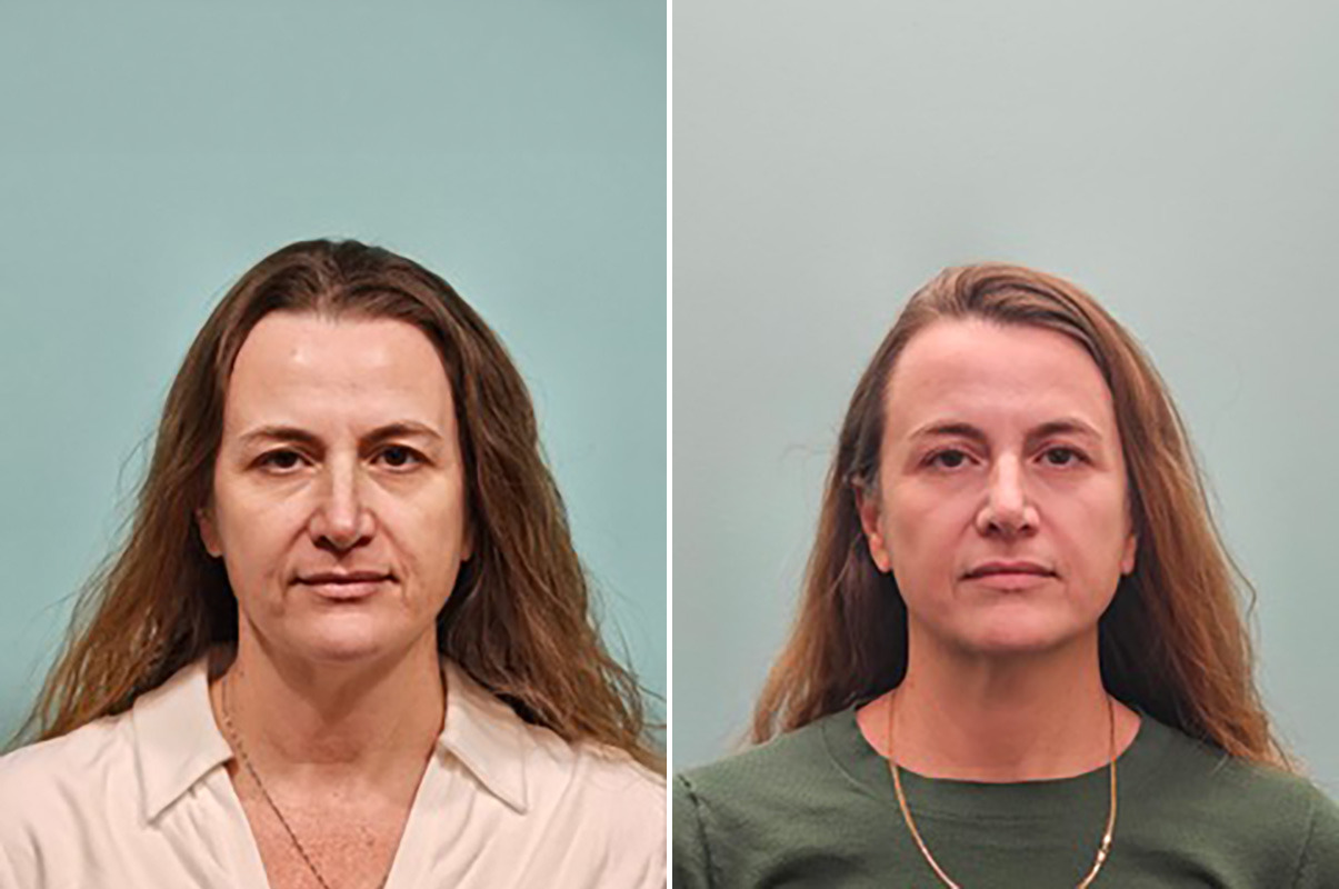 patient-50261-skin-resurfacing-before-after