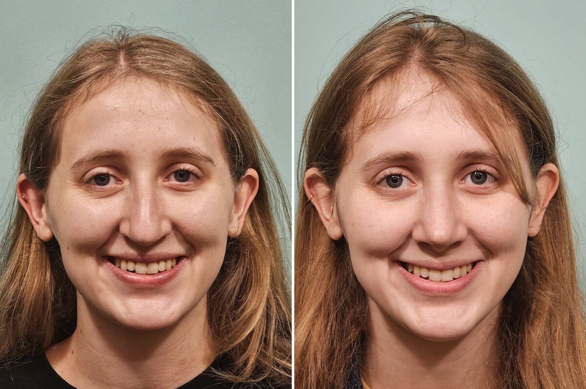 Before and after Rhinoplasty by Dr. Shervin Naderi, Patient 50289