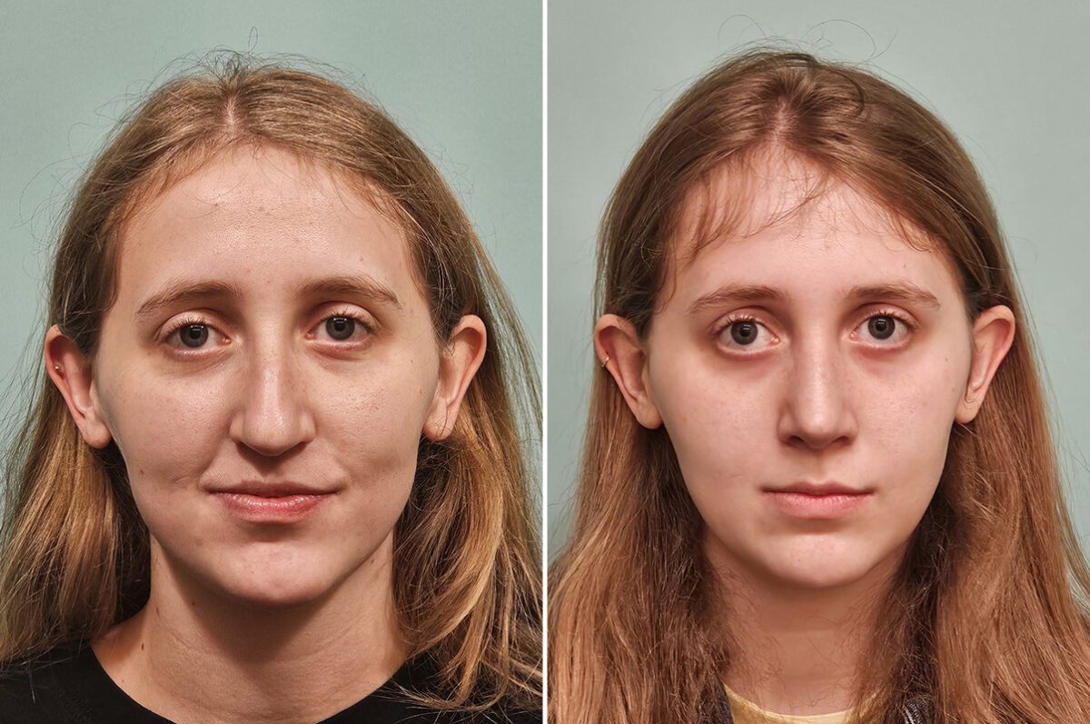 Before and after Rhinoplasty by Dr. Shervin Naderi, Patient 50289