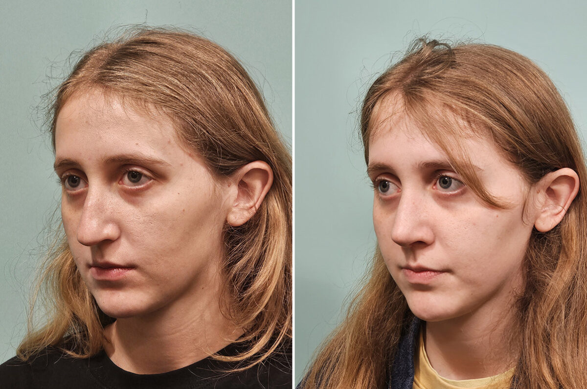 Before and after Rhinoplasty by Dr. Shervin Naderi, Patient 50289