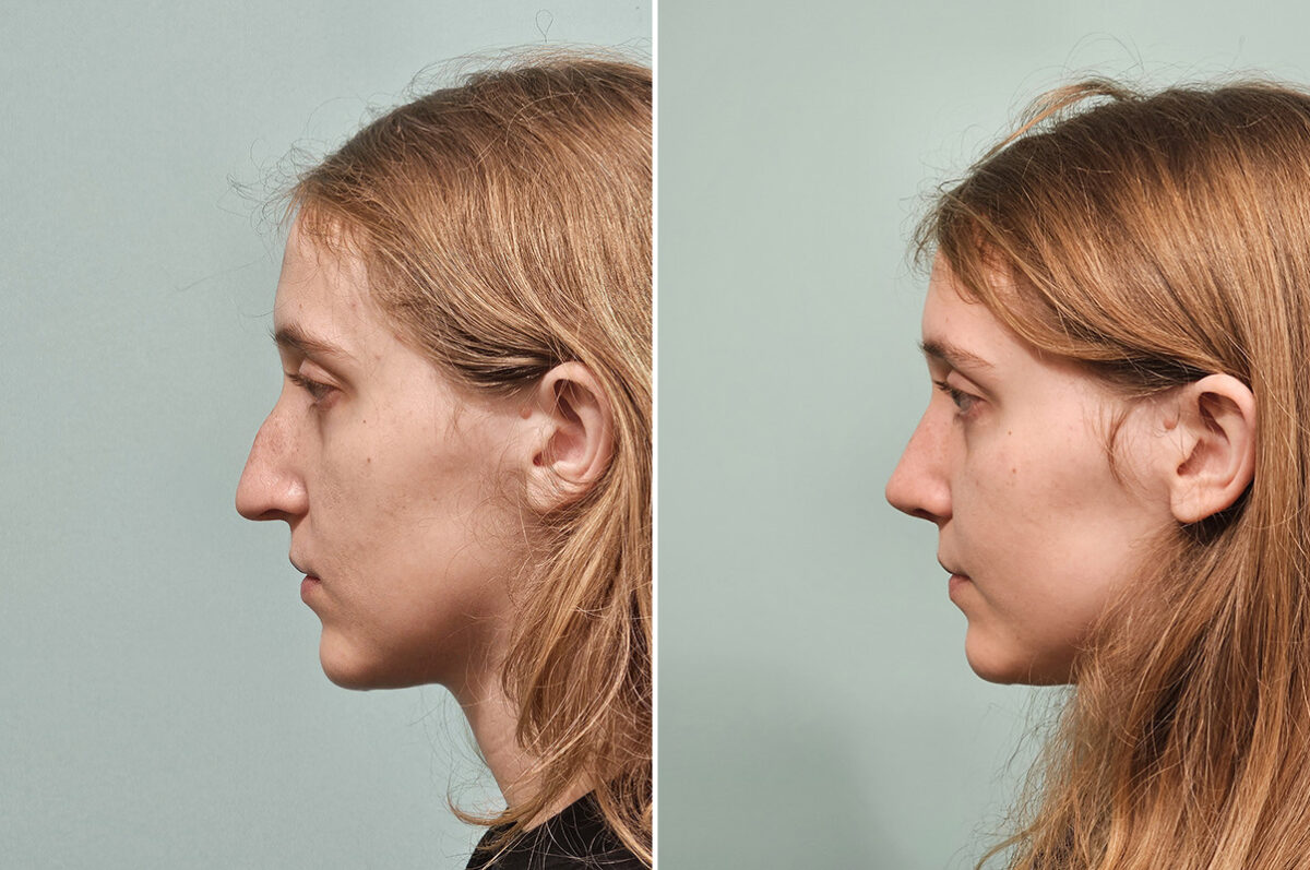 Before and after Rhinoplasty by Dr. Shervin Naderi, Patient 50289