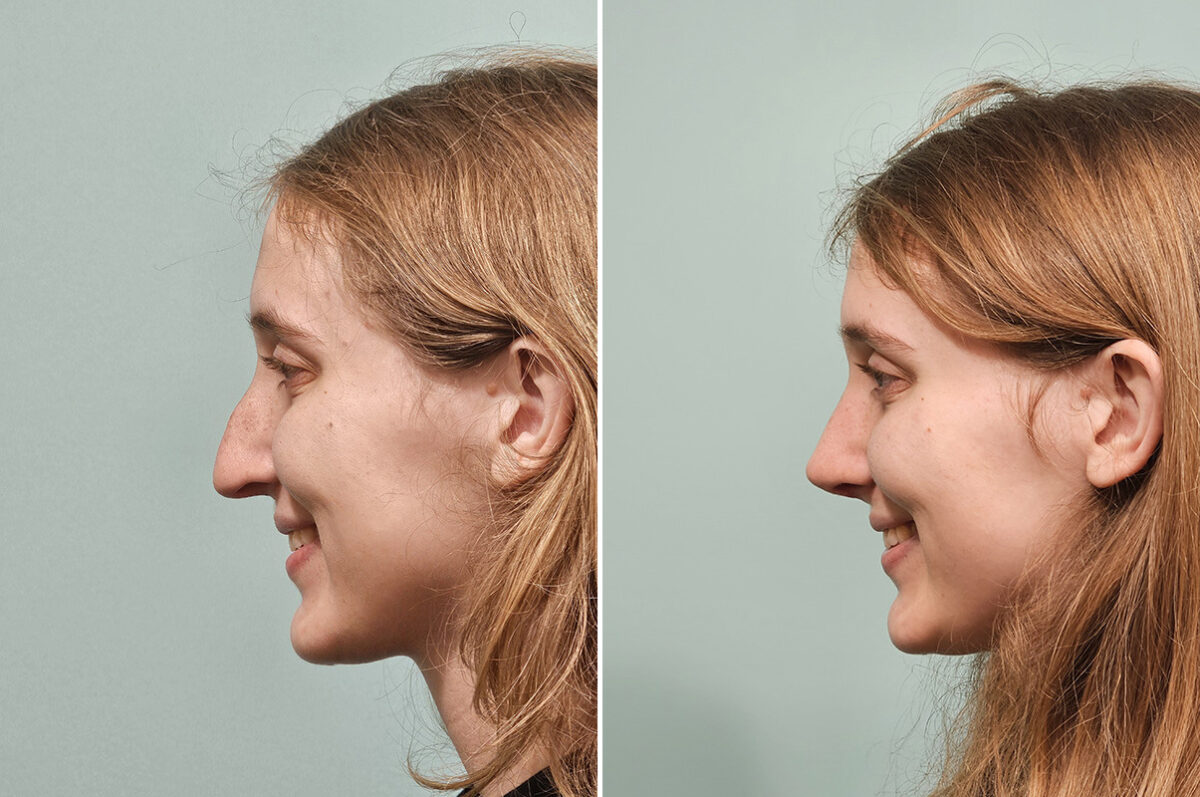 Before and after Rhinoplasty by Dr. Shervin Naderi, Patient 50289