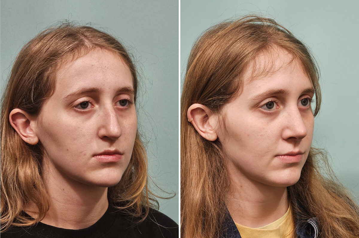 Before and after Rhinoplasty by Dr. Shervin Naderi, Patient 50289
