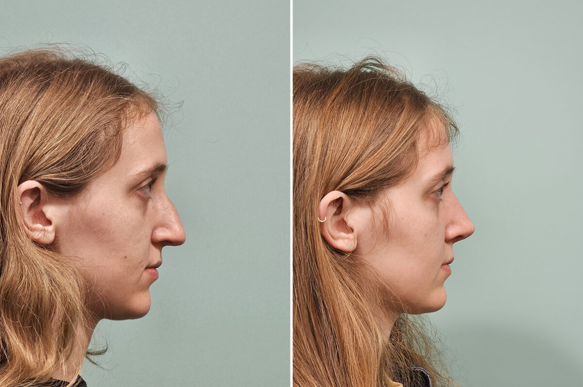 Before and after Rhinoplasty by Dr. Shervin Naderi, Patient 50289