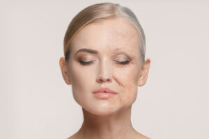 Split-face aging illustration showing how facial bone loss changes facial structure and contributes to visible aging.