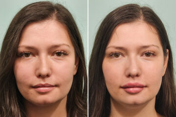 Before and after Lip Augmentation by Dr. Shervin Naderi, Patient 50381