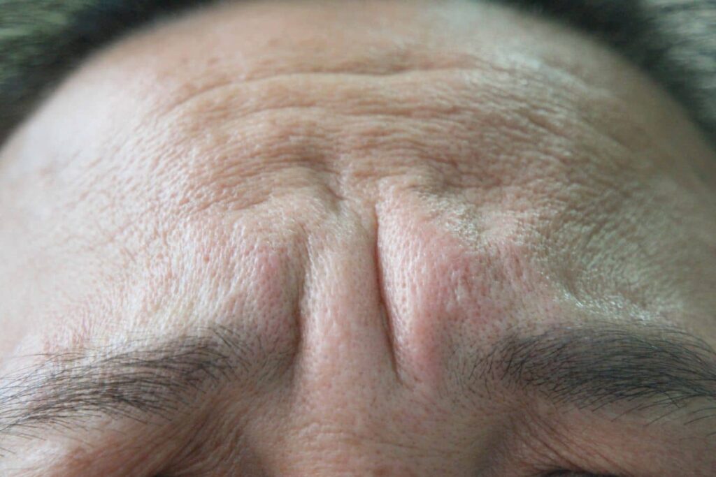 Close-up of pronounced glabella frown lines and forehead folds related to brow area volume loss.