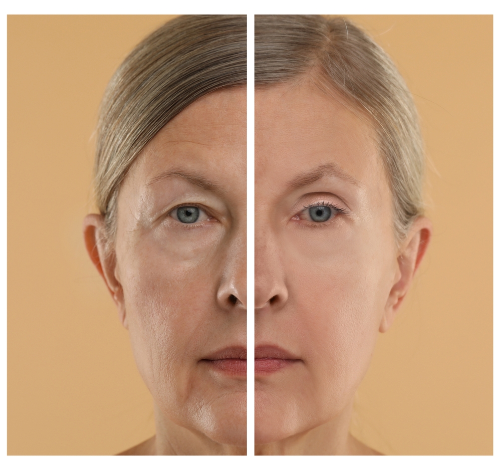 Split-face comparison showing facial aging and rejuvenation, illustrating structural evaluation during a facelift consultation.