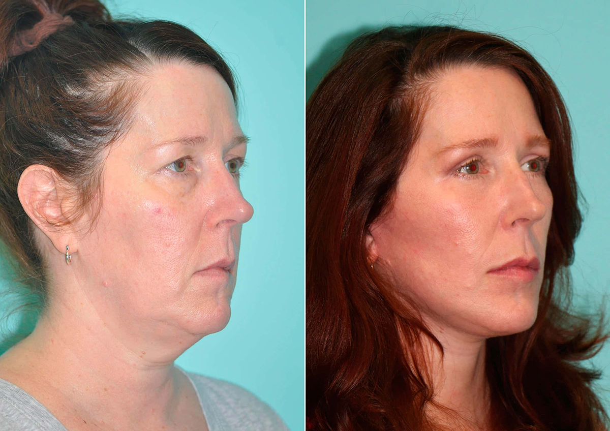 Facelift article section with before-and-after patient photos showing facial rejuvenation results.