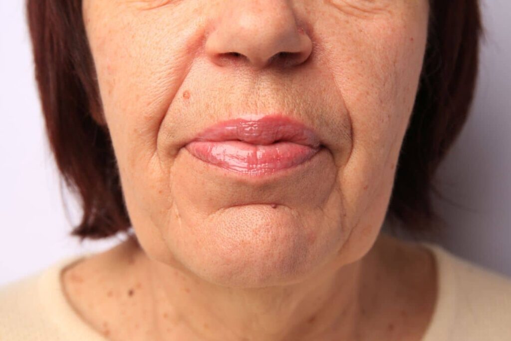 Close-up of a mature woman’s lower face showing jowls, volume loss, and reduced jawline definition.