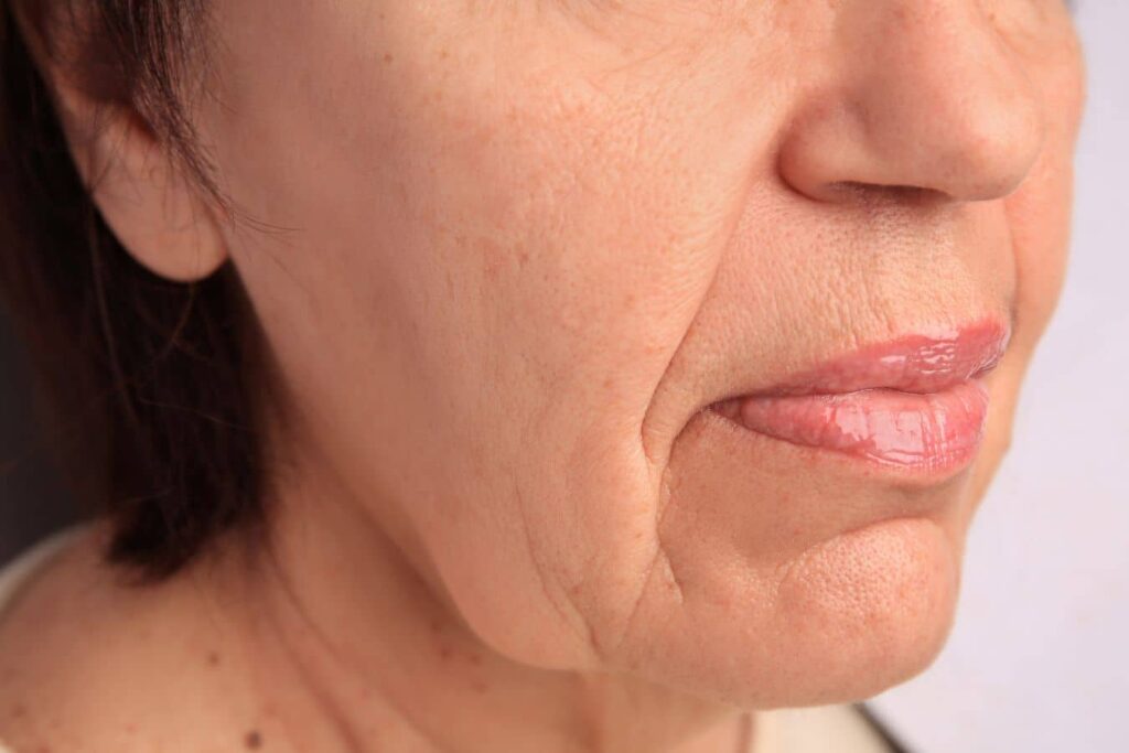 Close-up of facial aging with jowls, smile lines, and jawline changes