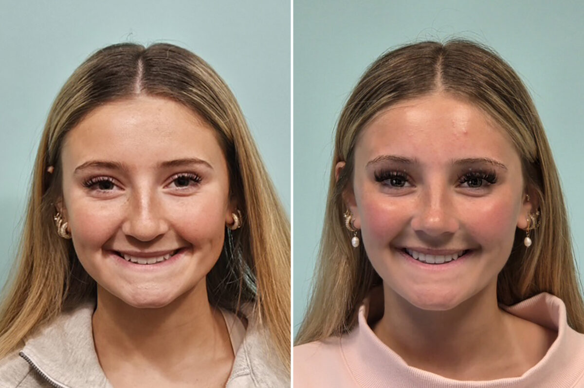 Before and after Rhinoplasty by Dr. Shervin Naderi, Patient 51067