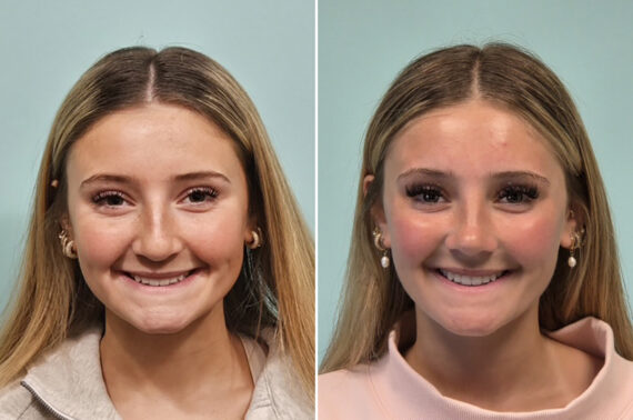 Before and after Rhinoplasty by Dr. Shervin Naderi, Patient 51067