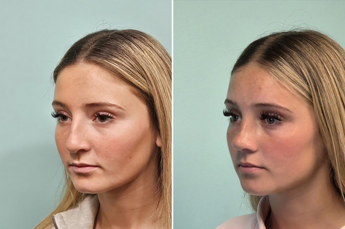 Before and after Rhinoplasty by Dr. Shervin Naderi, Patient 51067
