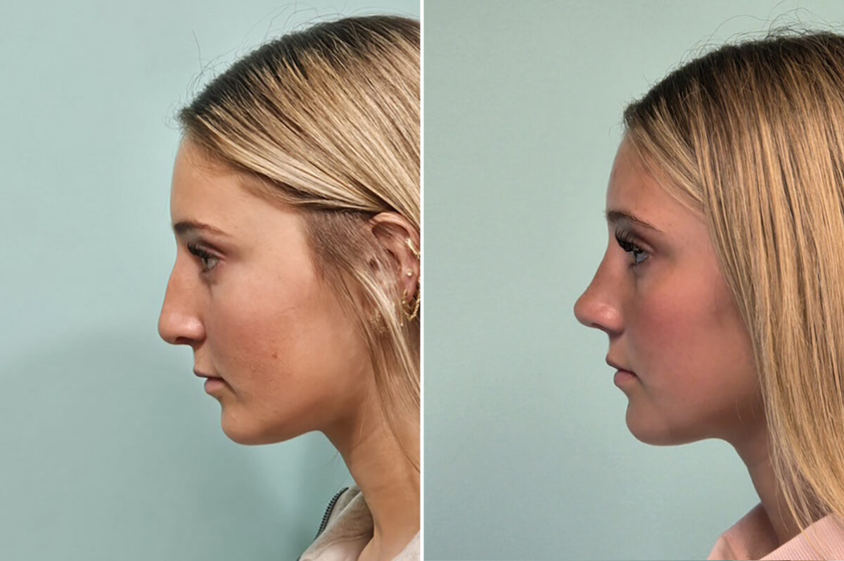 Before and after Rhinoplasty by Dr. Shervin Naderi, Patient 51067