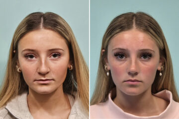 Before and after Rhinoplasty by Dr. Shervin Naderi, Patient 51067