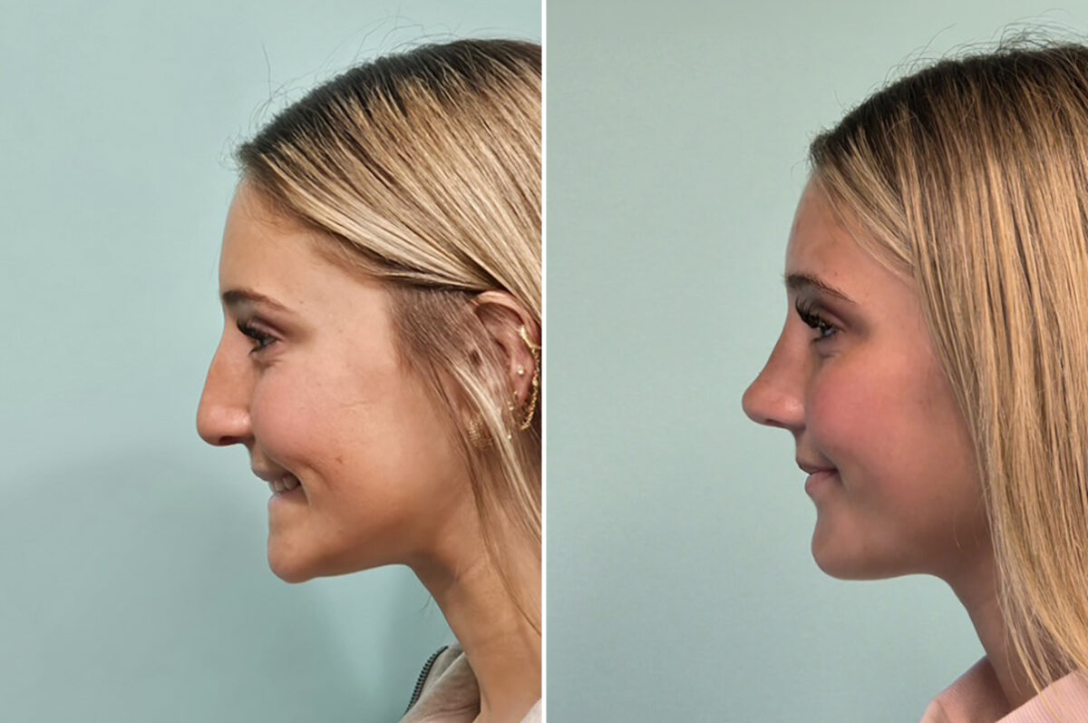 Before and after Rhinoplasty by Dr. Shervin Naderi, Patient 51067