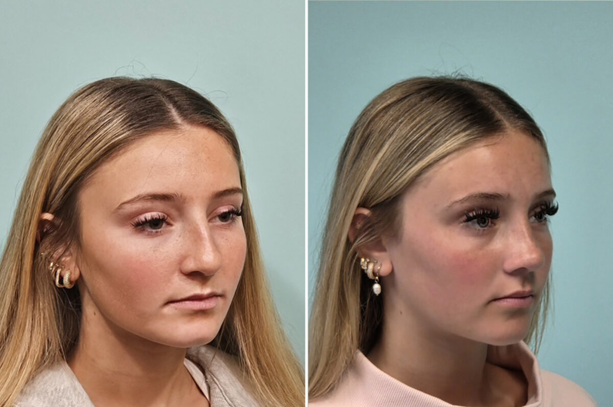 Before and after Rhinoplasty by Dr. Shervin Naderi, Patient 51067