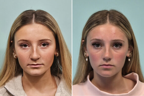 Before and after Rhinoplasty by Dr. Shervin Naderi, Patient 51067