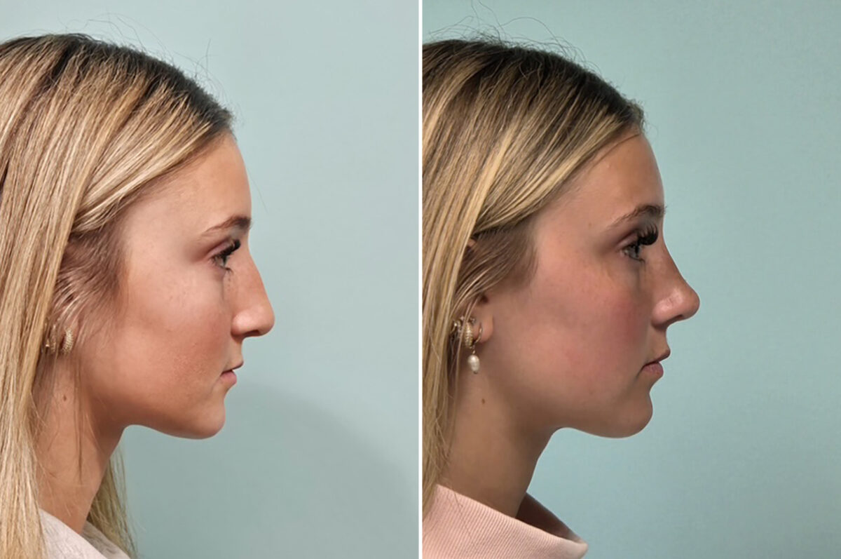 Before and after Rhinoplasty by Dr. Shervin Naderi, Patient 51067