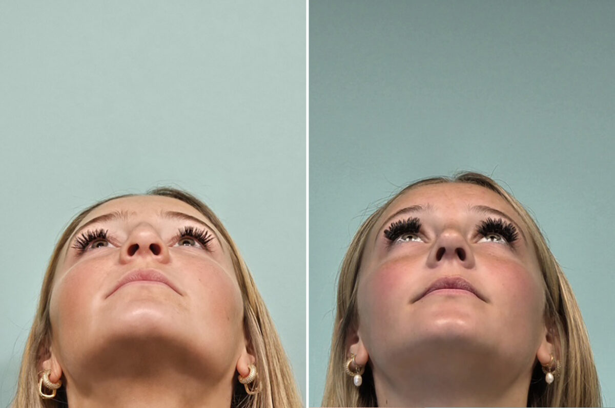 Before and after Rhinoplasty by Dr. Shervin Naderi, Patient 51067