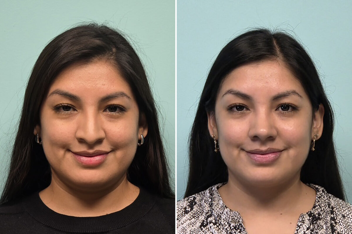 Before and after Rhinoplasty by Dr. Shervin Naderi, Patient 51120