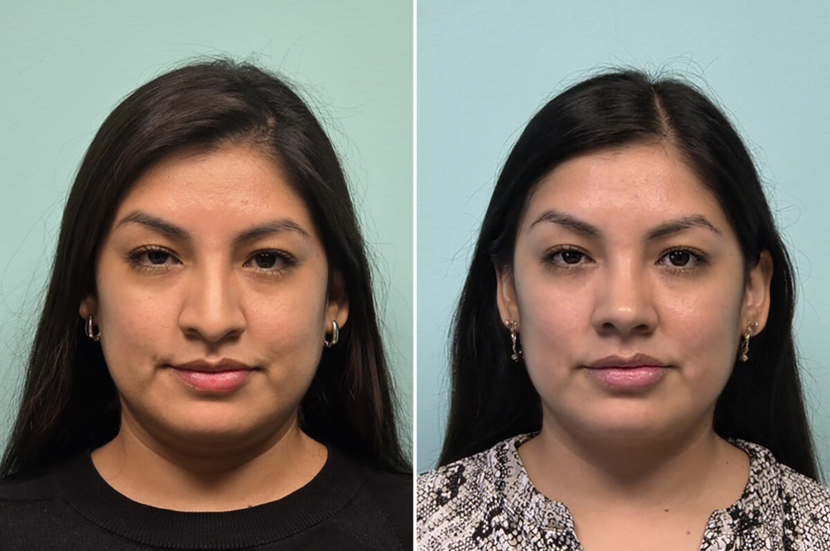 Before and after Rhinoplasty by Dr. Shervin Naderi, Patient 51120