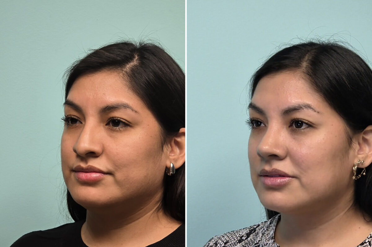Before and after Rhinoplasty by Dr. Shervin Naderi, Patient 51120