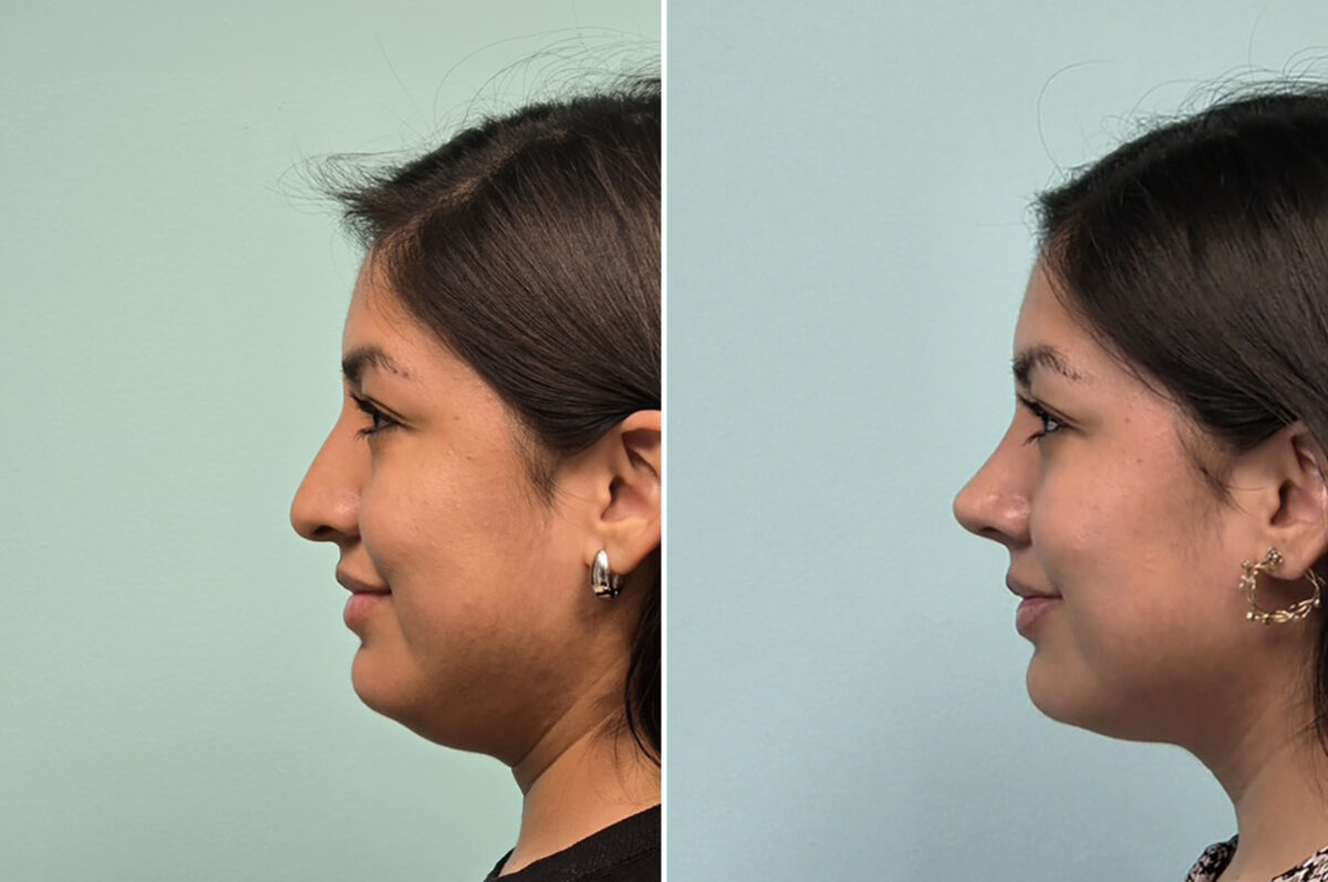 Before and after Rhinoplasty by Dr. Shervin Naderi, Patient 51120