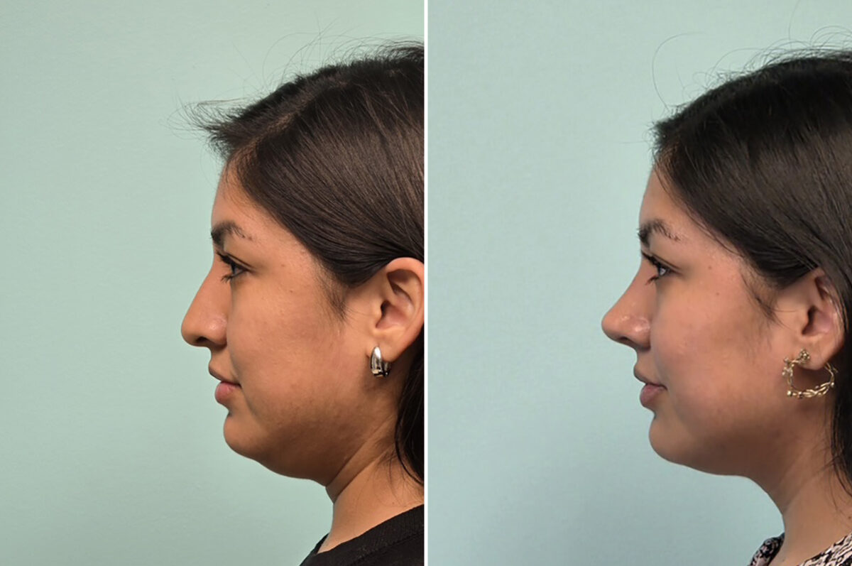 Before and after Rhinoplasty by Dr. Shervin Naderi, Patient 51120