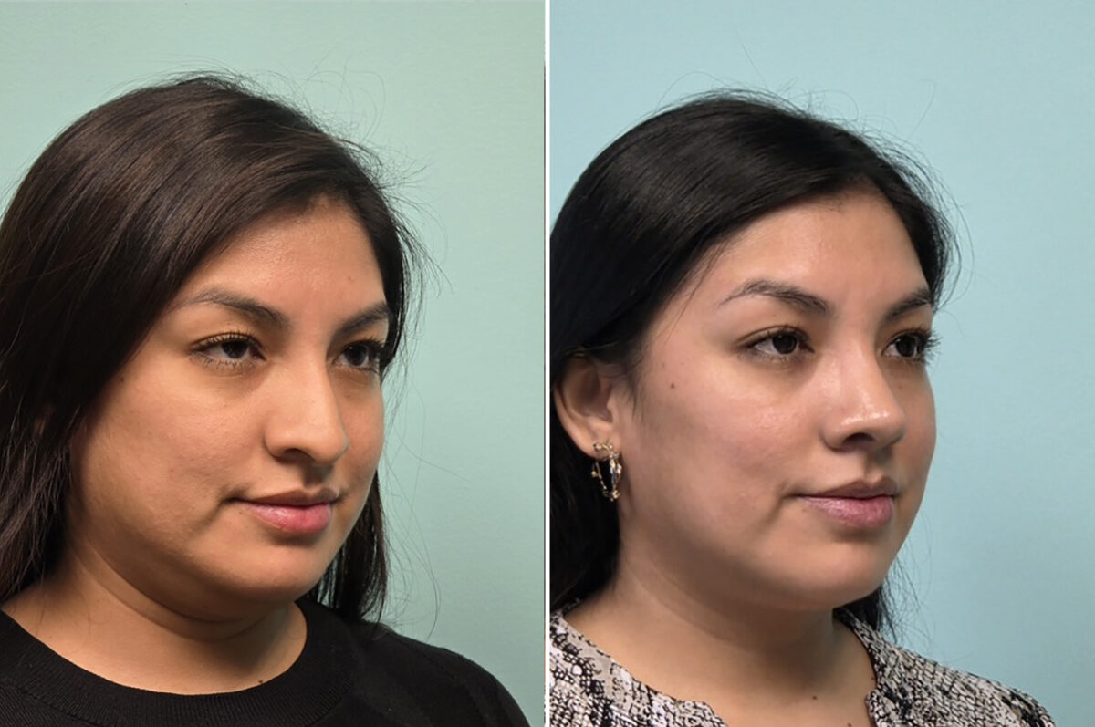 Before and after Rhinoplasty by Dr. Shervin Naderi, Patient 51120