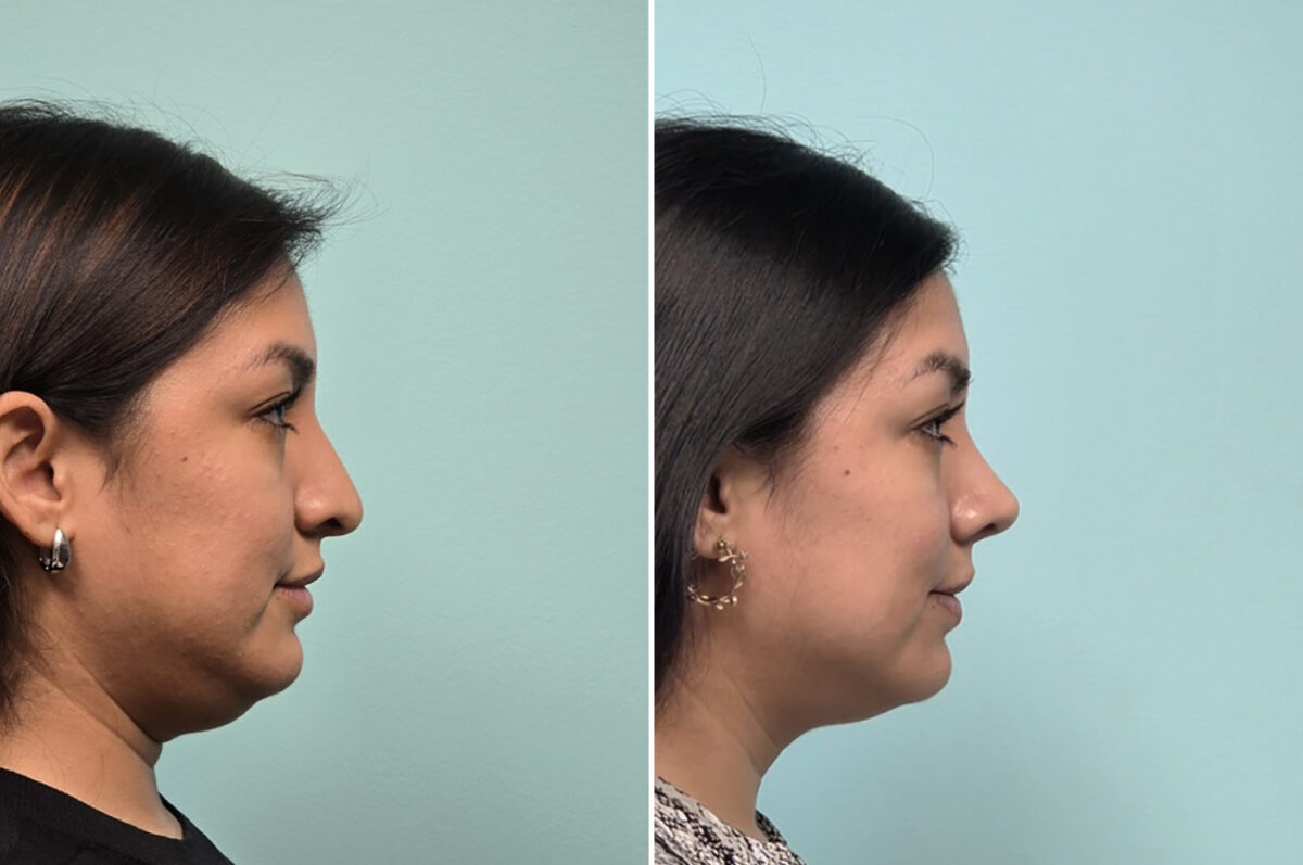 Before and after Rhinoplasty by Dr. Shervin Naderi, Patient 51120