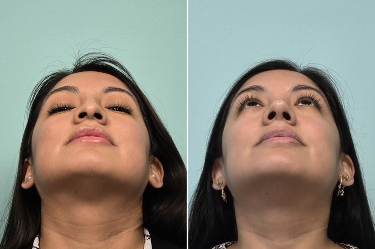 Before and after Rhinoplasty by Dr. Shervin Naderi, Patient 51120