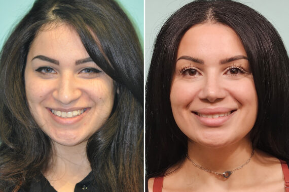 Before and after Rhinoplasty by Dr. Shervin Naderi, Patient 51129