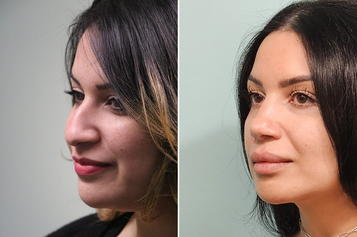 Before and after Rhinoplasty by Dr. Shervin Naderi, Patient 51129
