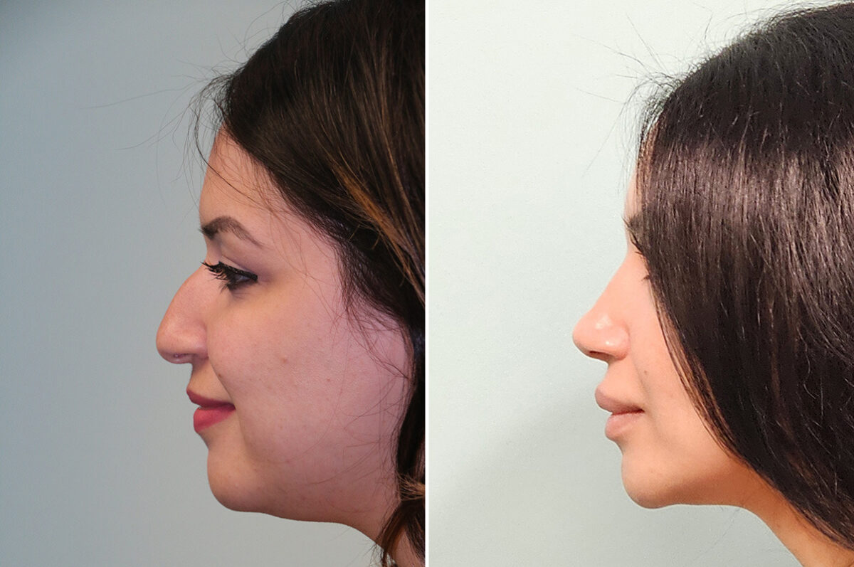 Before and after Rhinoplasty by Dr. Shervin Naderi, Patient 51129