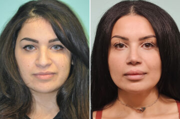 Before and after Rhinoplasty by Dr. Shervin Naderi, Patient 51129