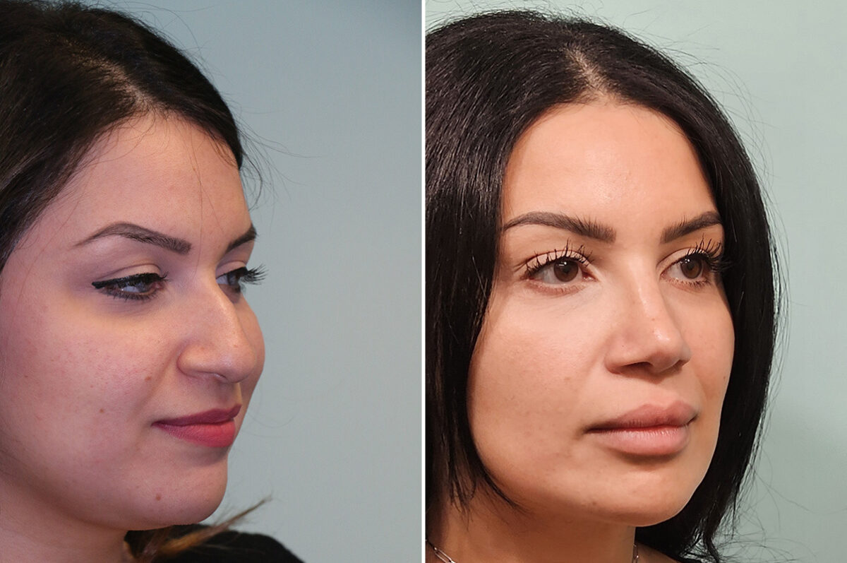 Before and after Rhinoplasty by Dr. Shervin Naderi, Patient 51129